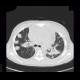 Aspergilosis of the lung, pericardial effusion, mediastinal lymphoma: CT - Computed tomography